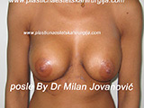 After breast augmentation