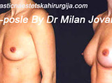 Before and after breast augmentation