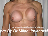 Before breast augmentation