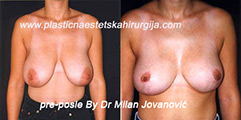 Before breast reduction | After four months