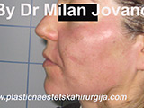 Face chemical peel after one day