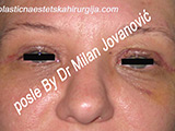 After eyelid surgery