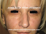 Result after facial fat grafting