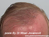 Results after one year after hair transplantation
