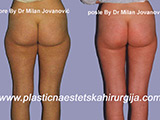 Result before and after liposuction