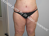 Result after liposuction