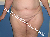 Result before liposuction