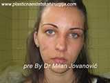Before scar removal