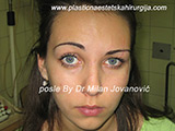 After scar removal