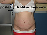 After tummy tuck