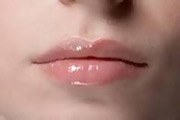 Lip Augmentation Surgery